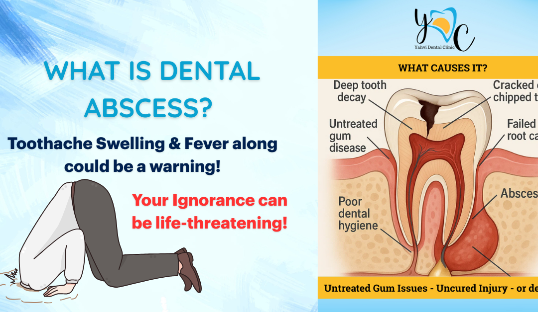 Severe Toothache with Swelling and Fever Can Be Life Threatening! Understanding the Dental Abscess Condition